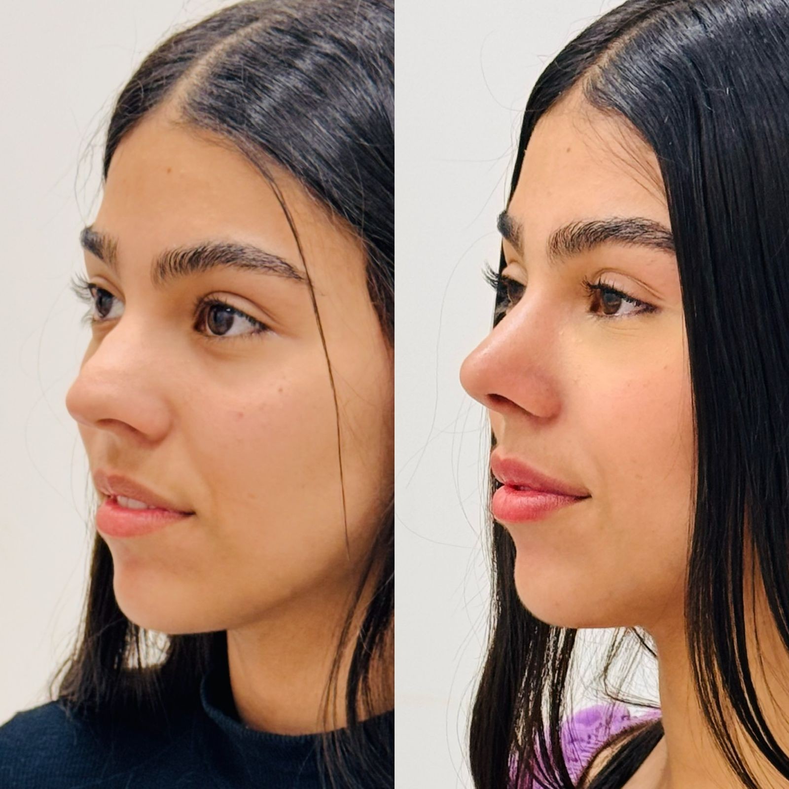 Antes e depois deRinomodelação